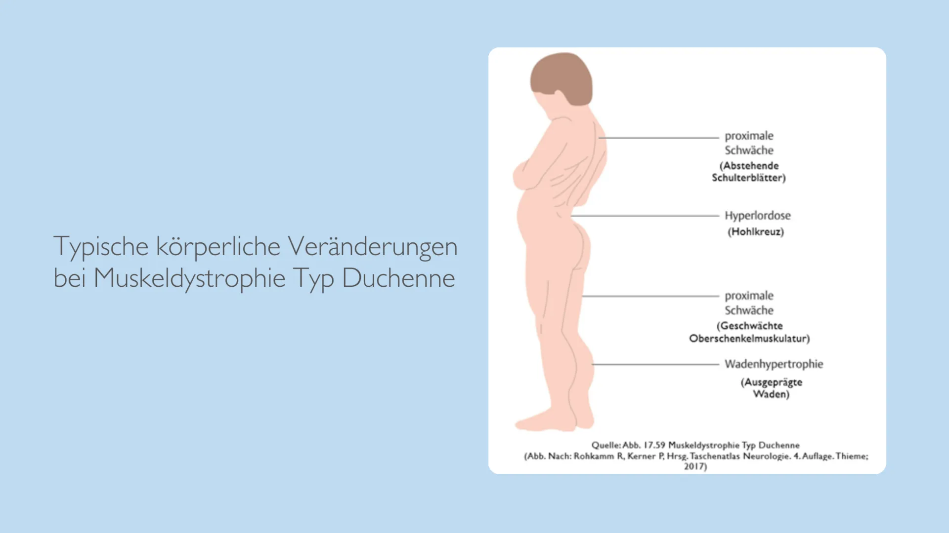 Seitliche Abbildung eines Jungen. Kennzeichnung der körperlichen Merkmale bei Duchenne Muskeldystrophie. Hervorstehende Schulterblätter, verkrümmte Wirbelsäule, geschwächte Oberschenkelmuskulatur und ausgeprägte Waden.