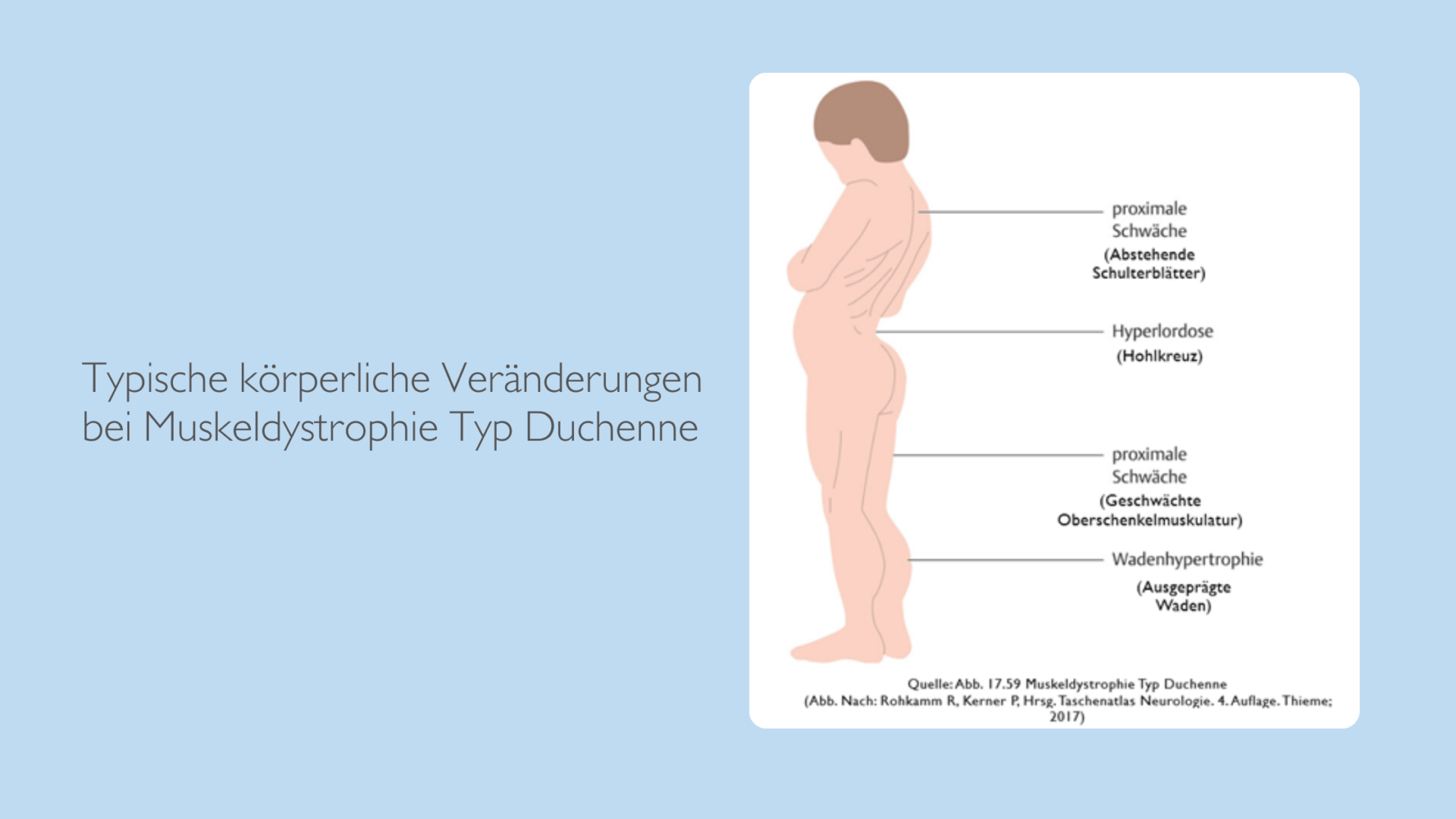 Seitliche Abbildung eines Jungen. Kennzeichnung der körperlichen Merkmale bei Duchenne Muskeldystrophie. Hervorstehende Schulterblätter, verkrümmte Wirbelsäule, geschwächte Oberschenkelmuskulatur und ausgeprägte Waden.