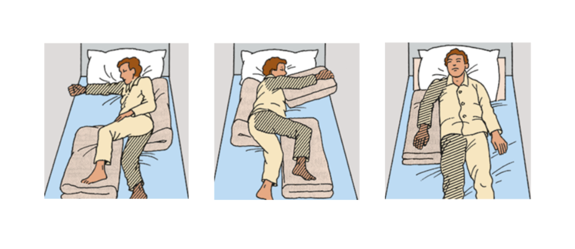 Dieses Bild zeigt die drei Variante, wie der Betroffene im Bett liegen kann. Das erste Bild zeigt Liegen auf der gelähmten Seite, dann auf der gesunden und zum Schluss auf dem Rücken.